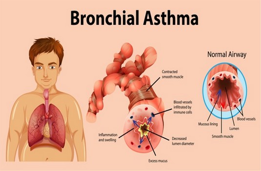 Bronchial Asthma 3